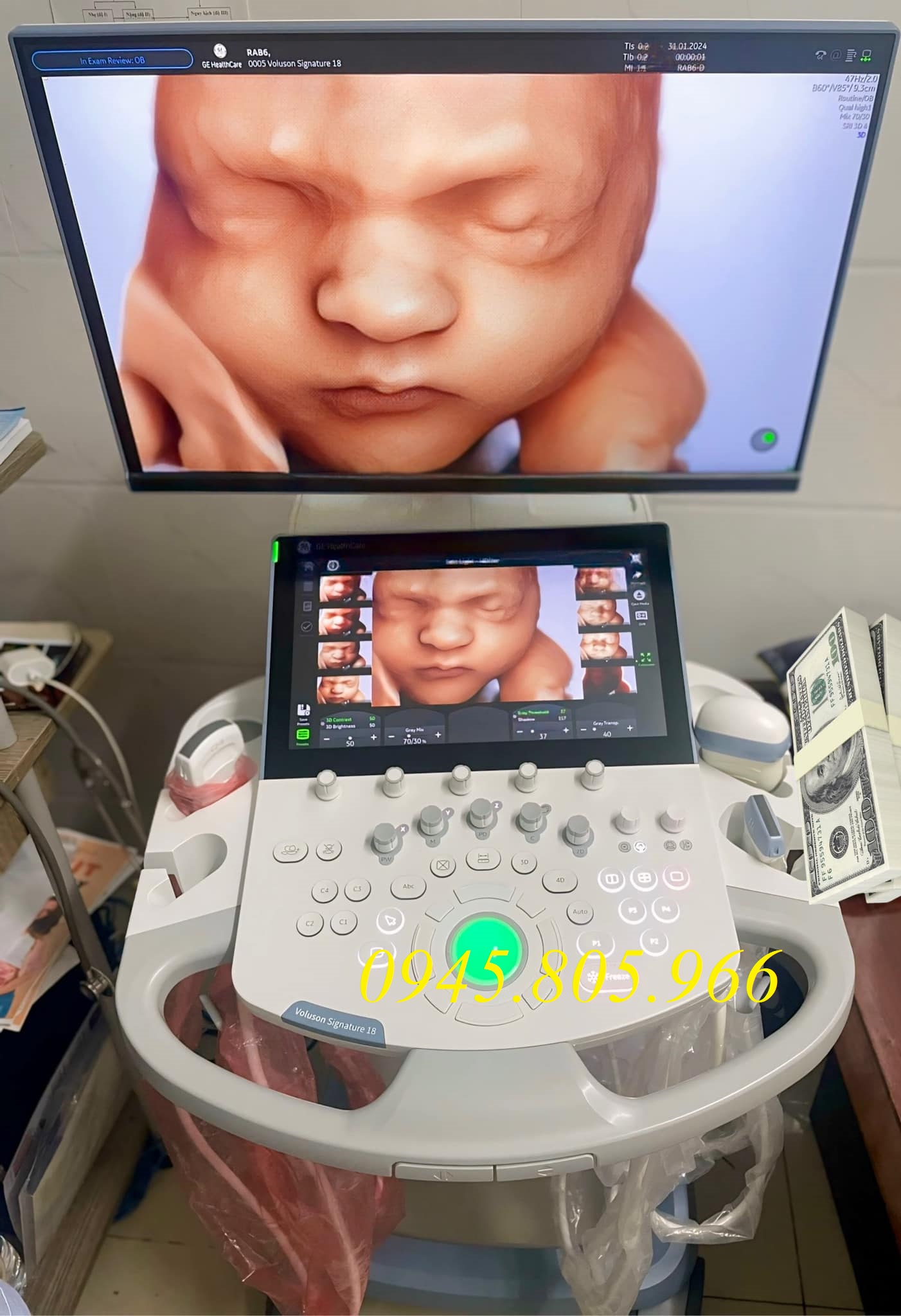 Các mức giá máy siêu âm màu phổ biến trên thị trường hiện nay